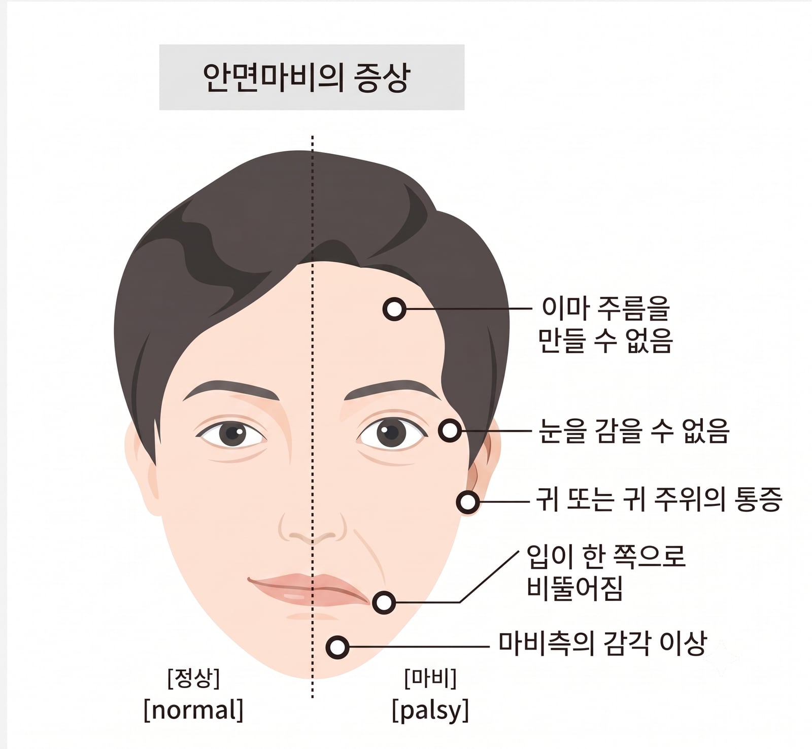 어느 날 아침, 한쪽 눈이 감기지 않는다면 — 안면마비(구안와사)